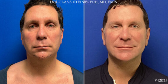 Chin Implant Before and After Photos in CA, Beverly Hills, Patient 24999