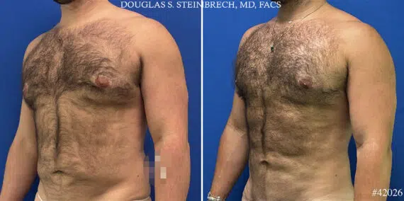 Hi-Def Liposuction Before and After Photos in CA, Beverly Hills, Patient 25009