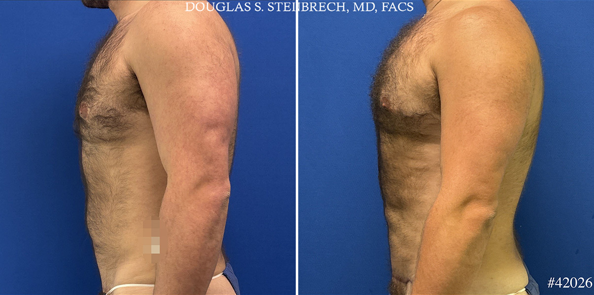 Hi-Def Liposuction Before and After Photos in CA, Beverly Hills, Patient 25009