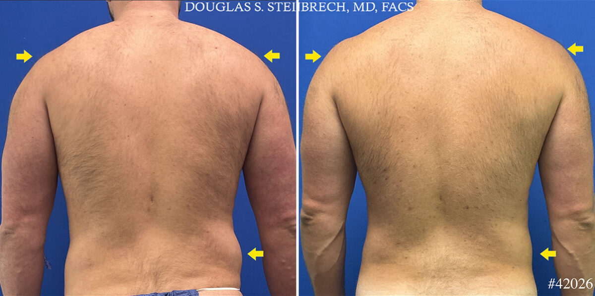 Patient 25009, Hi-Def Liposuction Before and After Photos Hi-Def Liposuction Before and After Photos in CA, Beverly Hills, Patient 25009