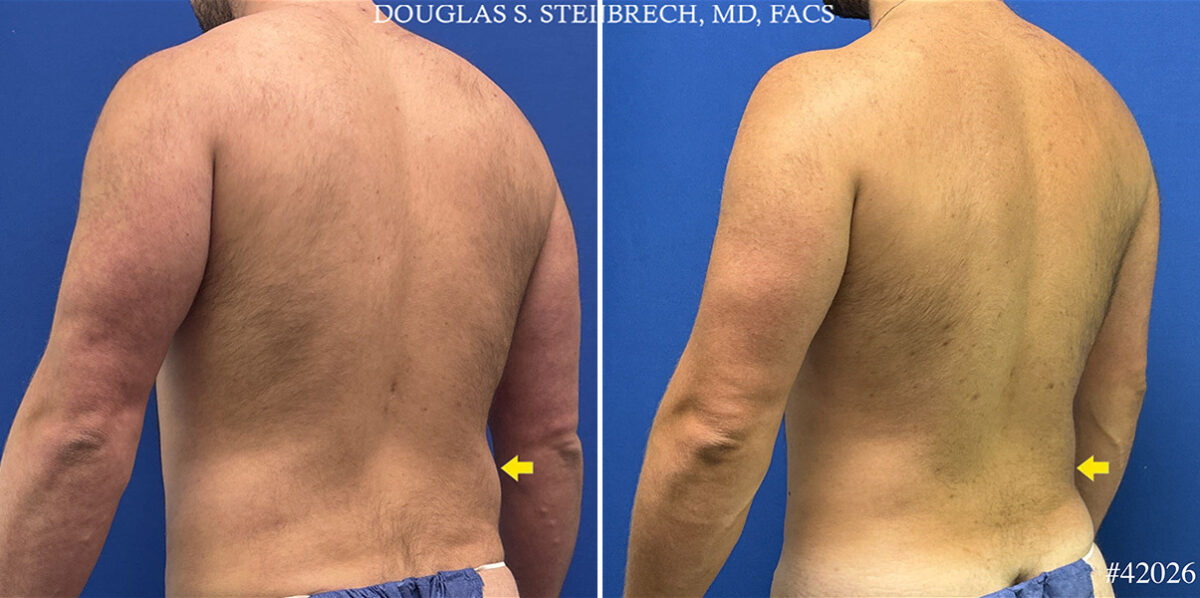 Patient 25009, Hi-Def Liposuction Before and After Photos Hi-Def Liposuction Before and After Photos in CA, Beverly Hills, Patient 25009