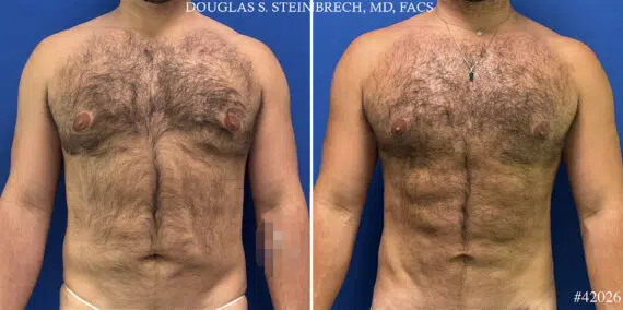 Hi-Def Liposuction Before and After Photos in CA, Beverly Hills, Patient 25009