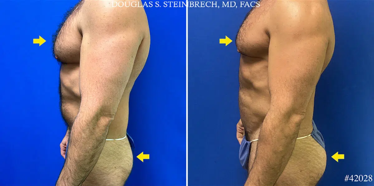 Patient 25098, Body Banking Before and After Photos Body Banking Before and After Photos in CA, Beverly Hills, Patient 25098