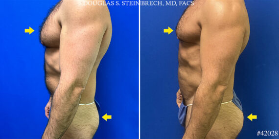 Body Banking Before and After Photos in CA, Beverly Hills, Patient 25098