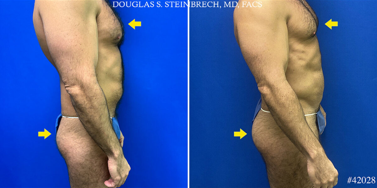 Patient 25098, Body Banking Before and After Photos Body Banking Before and After Photos in CA, Beverly Hills, Patient 25098