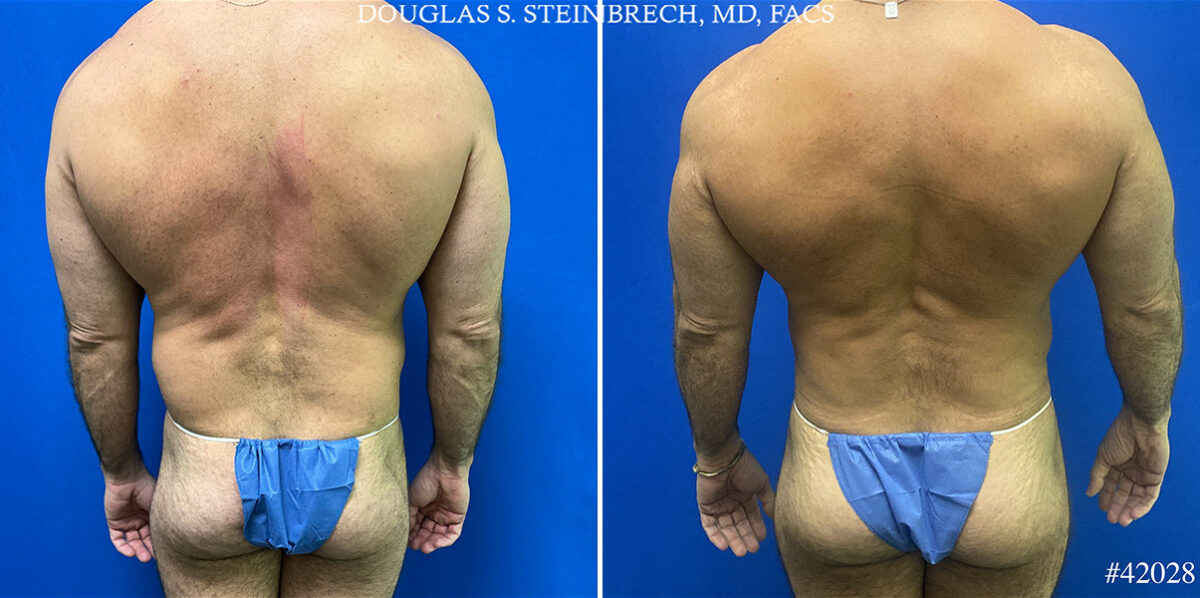 Patient 25098, Body Banking Before and After Photos Body Banking Before and After Photos in CA, Beverly Hills, Patient 25098