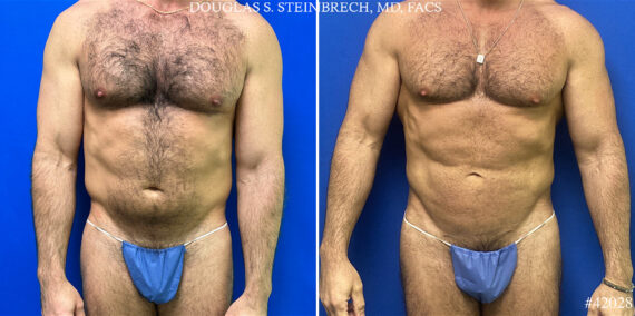 Body Banking Before and After Photos in CA, Beverly Hills, Patient 25098
