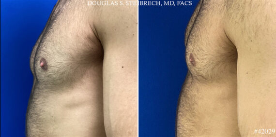 Nipple Reduction Before and After Photos in CA, Beverly Hills, Patient 25111