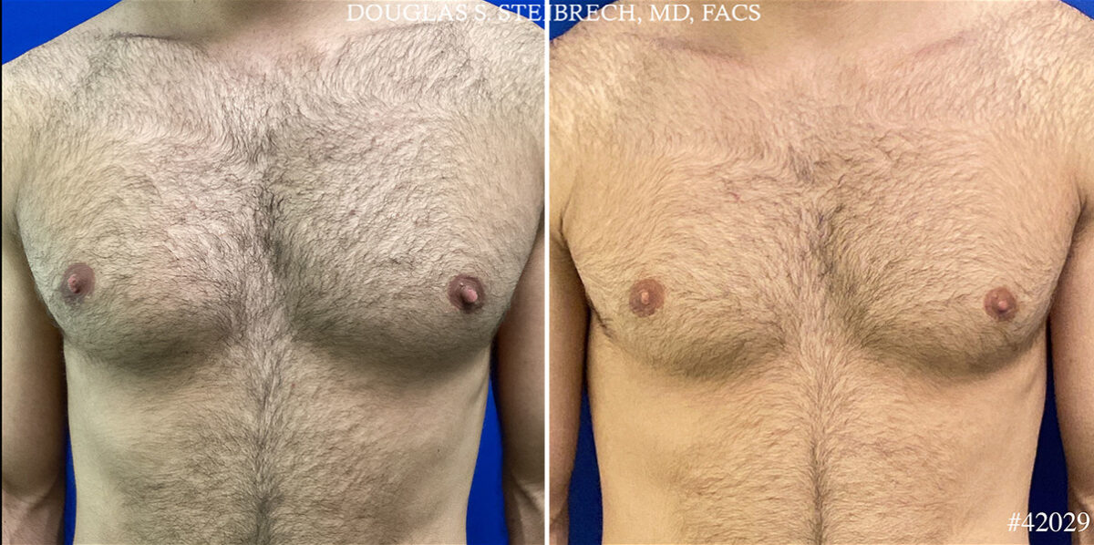 Patient 25111, Nipple Reduction Before and After Photos Nipple Reduction Before and After Photos in CA, Beverly Hills, Patient 25111