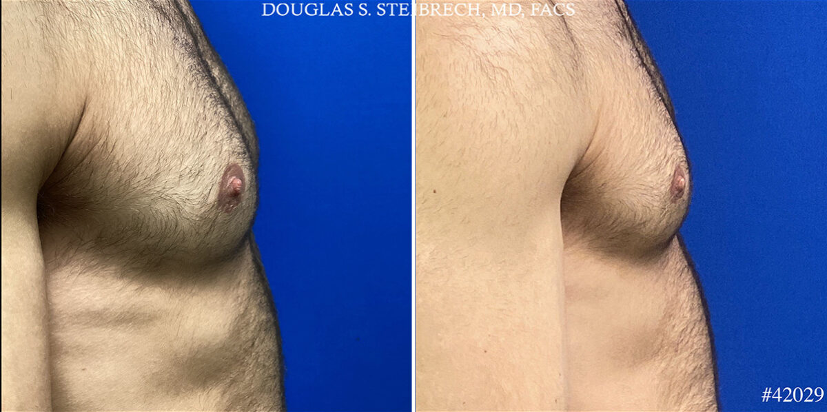 Patient 25111, Nipple Reduction Before and After Photos Nipple Reduction Before and After Photos in CA, Beverly Hills, Patient 25111