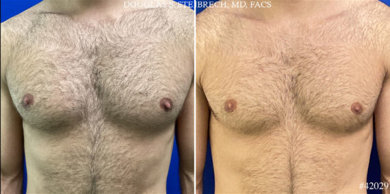 Nipple Reduction Before and After Photos in CA, Beverly Hills, Patient 25111
