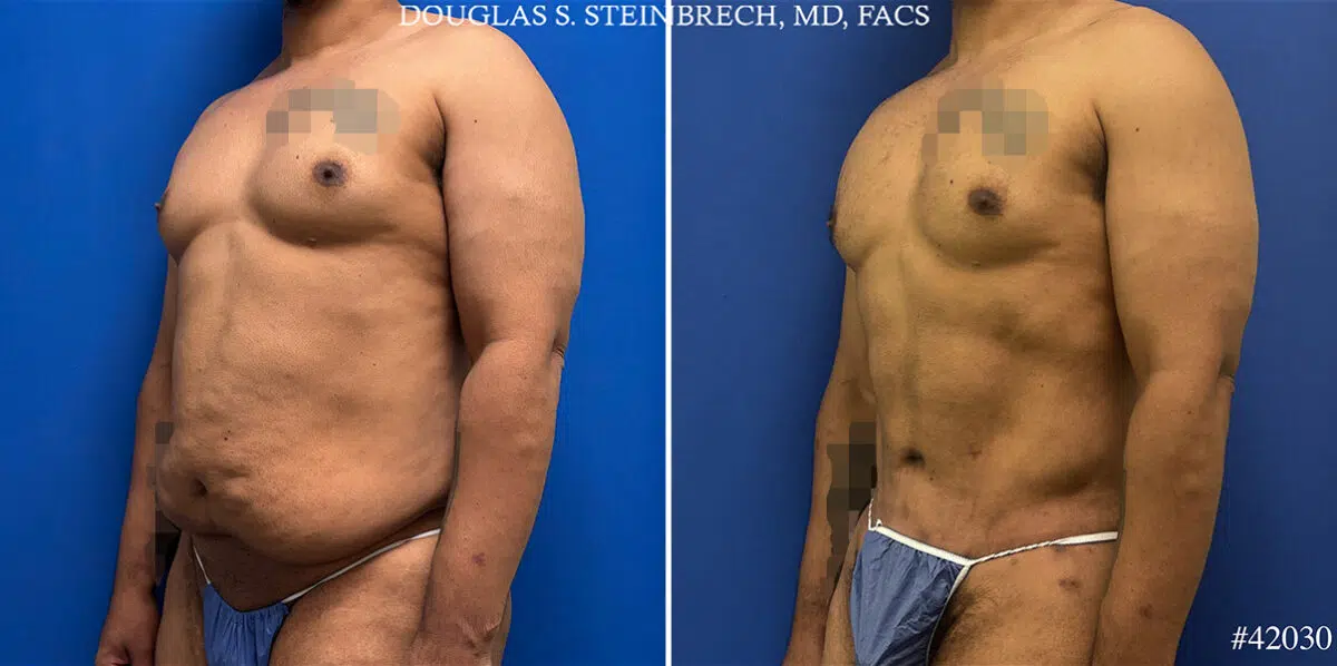 Patient 25121, Body Banking Before and After Photos Body Banking Before and After Photos in CA, Beverly Hills, Patient 25121