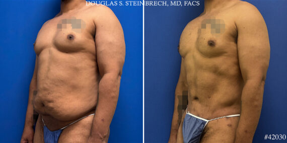 Body Banking Before and After Photos in CA, Beverly Hills, Patient 25121