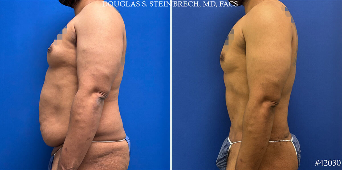 Patient 25121, Body Banking Before and After Photos Body Banking Before and After Photos in CA, Beverly Hills, Patient 25121