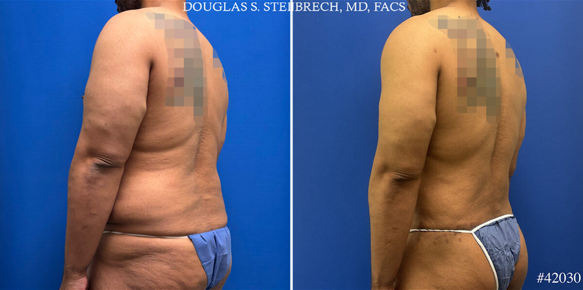 Patient 25121, Body Banking Before and After Photos Body Banking Before and After Photos in CA, Beverly Hills, Patient 25121