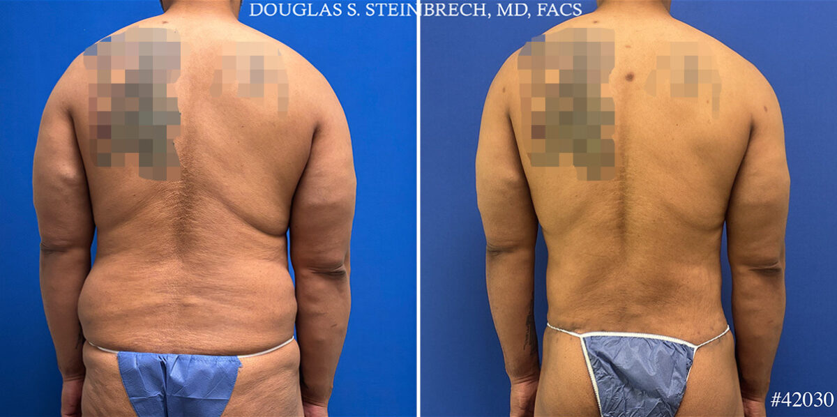 Patient 25121, Body Banking Before and After Photos Body Banking Before and After Photos in CA, Beverly Hills, Patient 25121