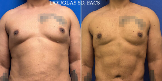 Body Banking Before and After Photos in CA, Beverly Hills, Patient 25121