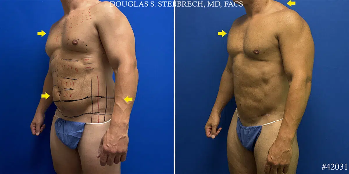 Patient 25137, Body Banking Before and After Photos Body Banking Before and After Photos in CA, Beverly Hills, Patient 25137