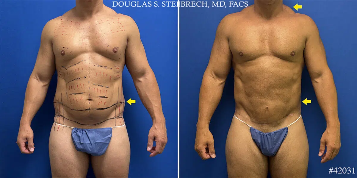 Patient 25137, Body Banking Before and After Photos Body Banking Before and After Photos in CA, Beverly Hills, Patient 25137