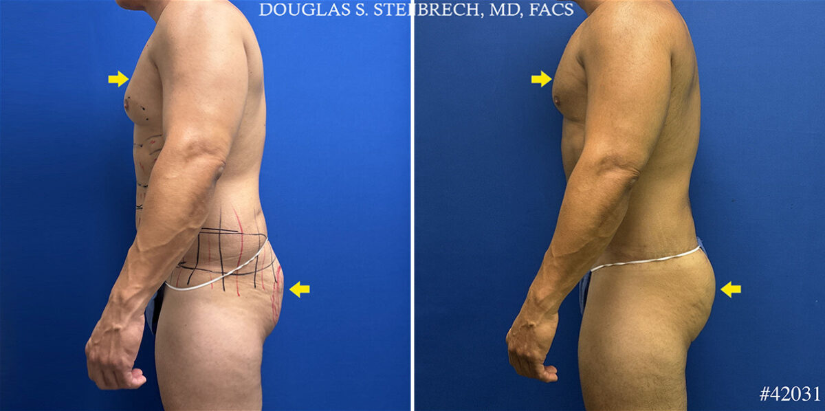 Patient 25137, Body Banking Before and After Photos Body Banking Before and After Photos in CA, Beverly Hills, Patient 25137