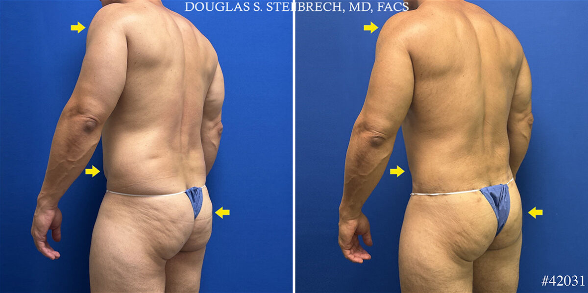 Patient 25137, Body Banking Before and After Photos Body Banking Before and After Photos in CA, Beverly Hills, Patient 25137