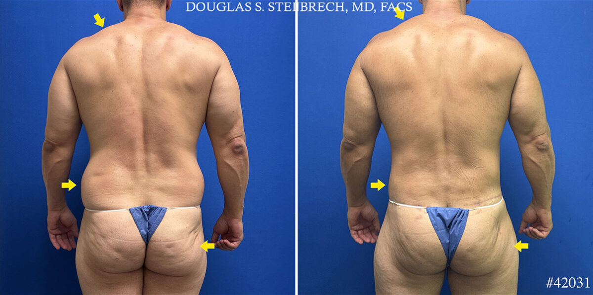 Patient 25137, Body Banking Before and After Photos Body Banking Before and After Photos in CA, Beverly Hills, Patient 25137