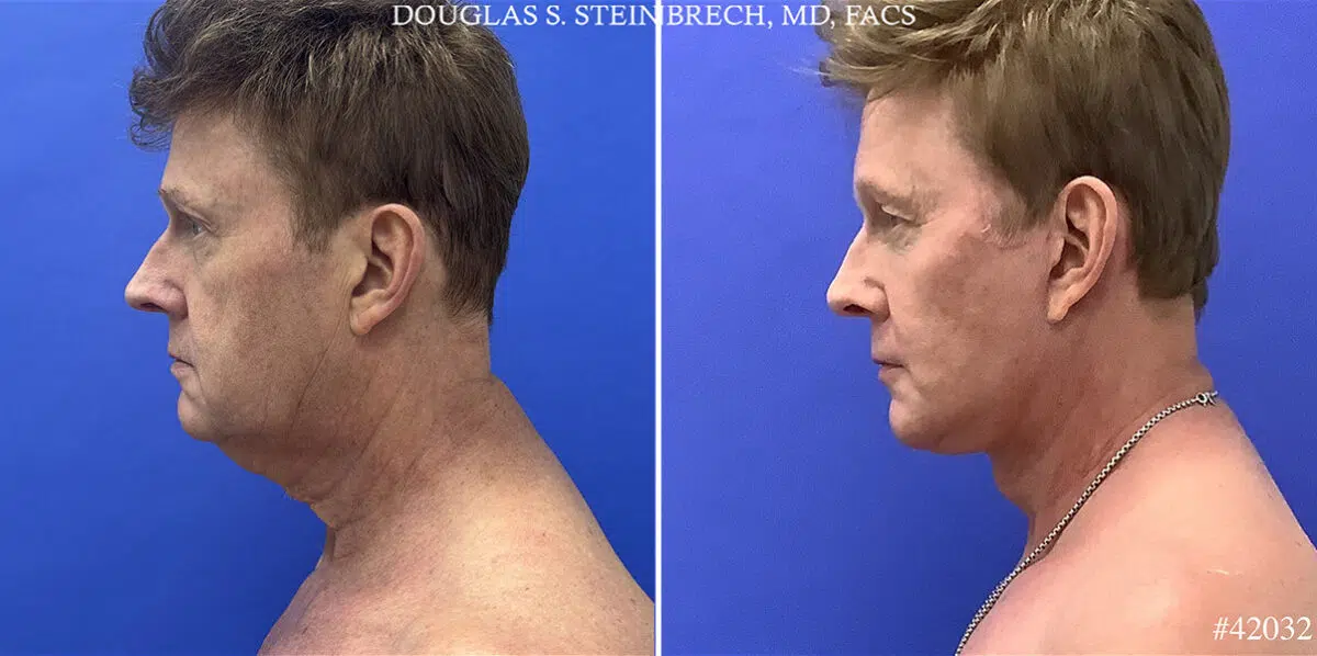 Facelift Before and After Photos in CA, Beverly Hills, Patient 25158