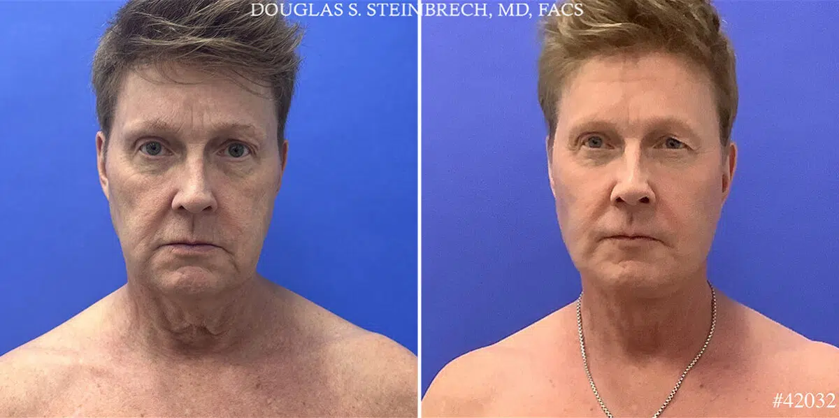 Facelift Before and After Photos in CA, Beverly Hills, Patient 25158