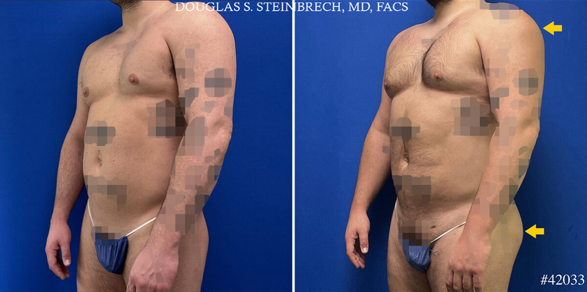 Body Banking Before and After Photos in CA, Beverly Hills, Patient 25292