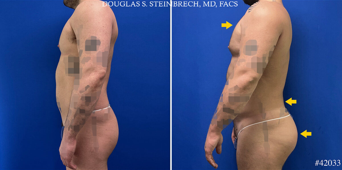 Body Banking Before and After Photos in CA, Beverly Hills, Patient 25292