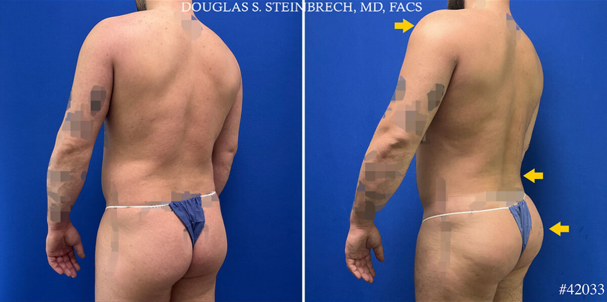 Body Banking Before and After Photos in CA, Beverly Hills, Patient 25292