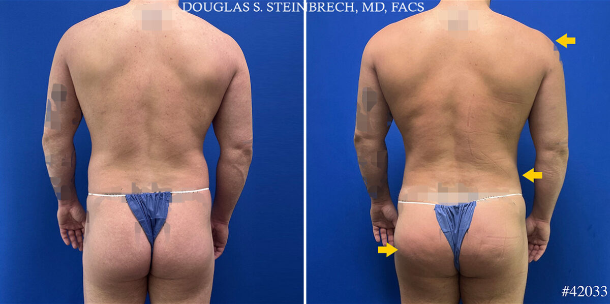 Body Banking Before and After Photos in CA, Beverly Hills, Patient 25292