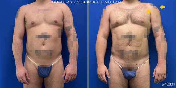 Body Banking Before and After Photos in CA, Beverly Hills, Patient 25292