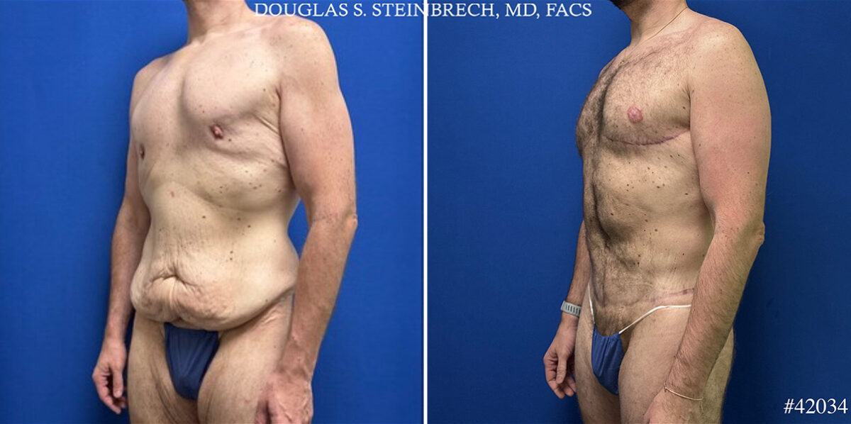 Body Banking Before and After Photos in CA, Beverly Hills, Patient 25308