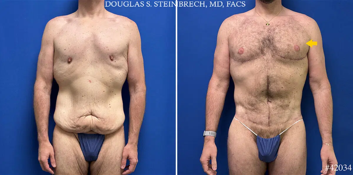 Body Banking Before and After Photos in CA, Beverly Hills, Patient 25308