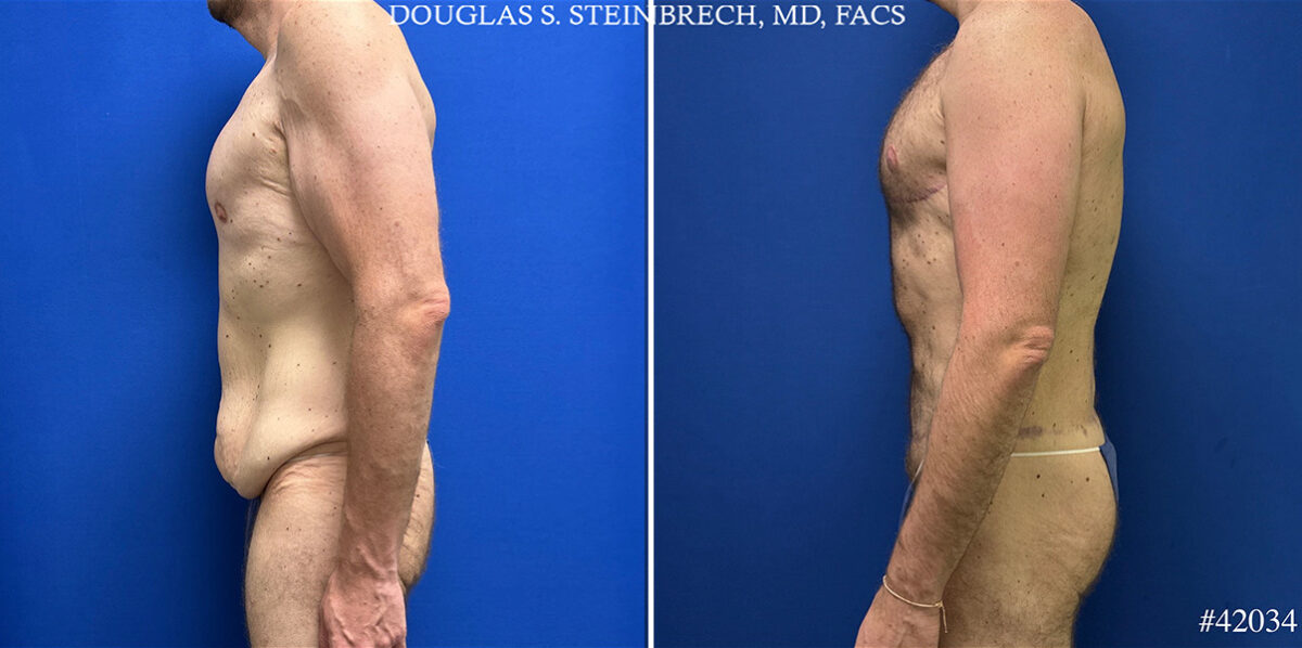 Body Banking Before and After Photos in CA, Beverly Hills, Patient 25308