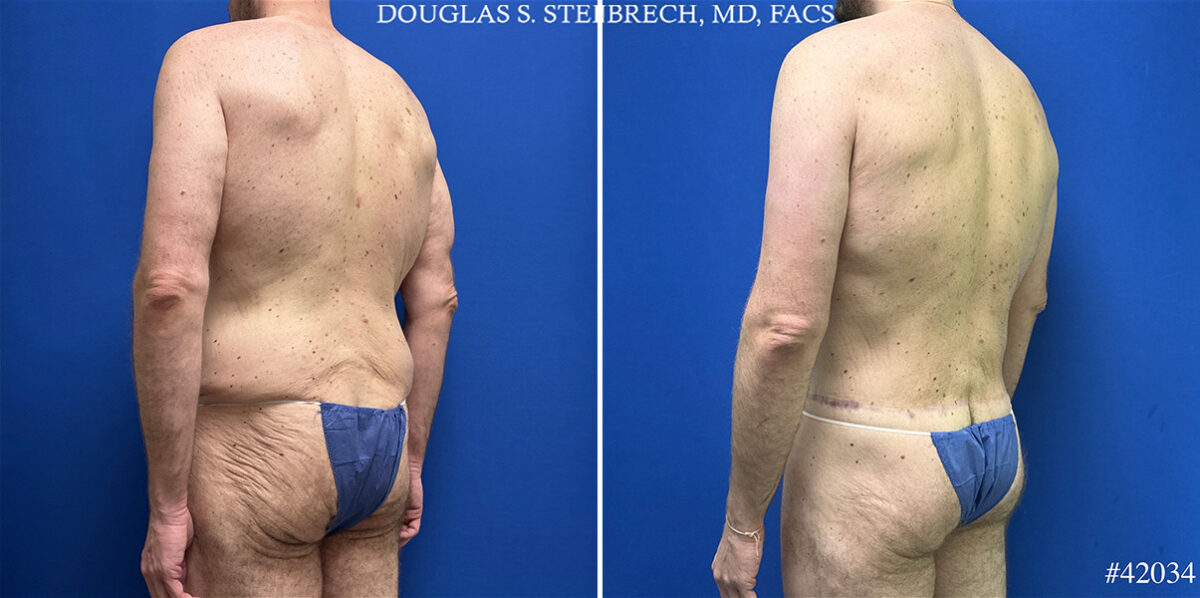 Body Banking Before and After Photos in CA, Beverly Hills, Patient 25308