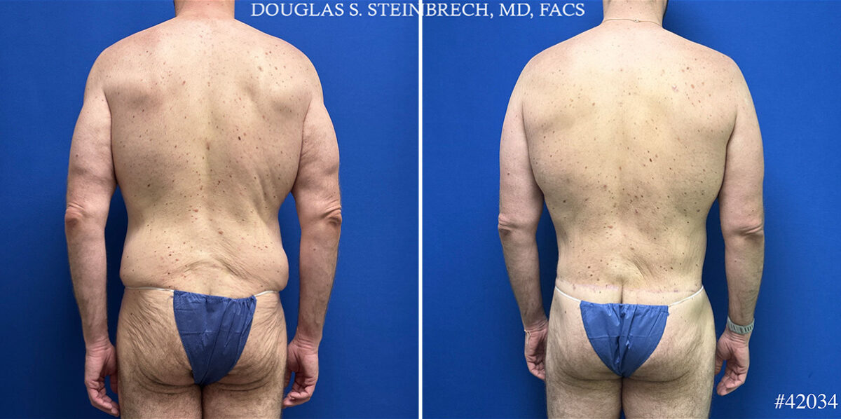Body Banking Before and After Photos in CA, Beverly Hills, Patient 25308