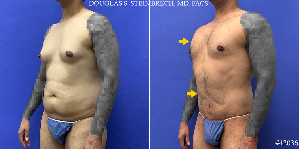 Body Banking Before and After Photos in CA, Beverly Hills, Patient 25324