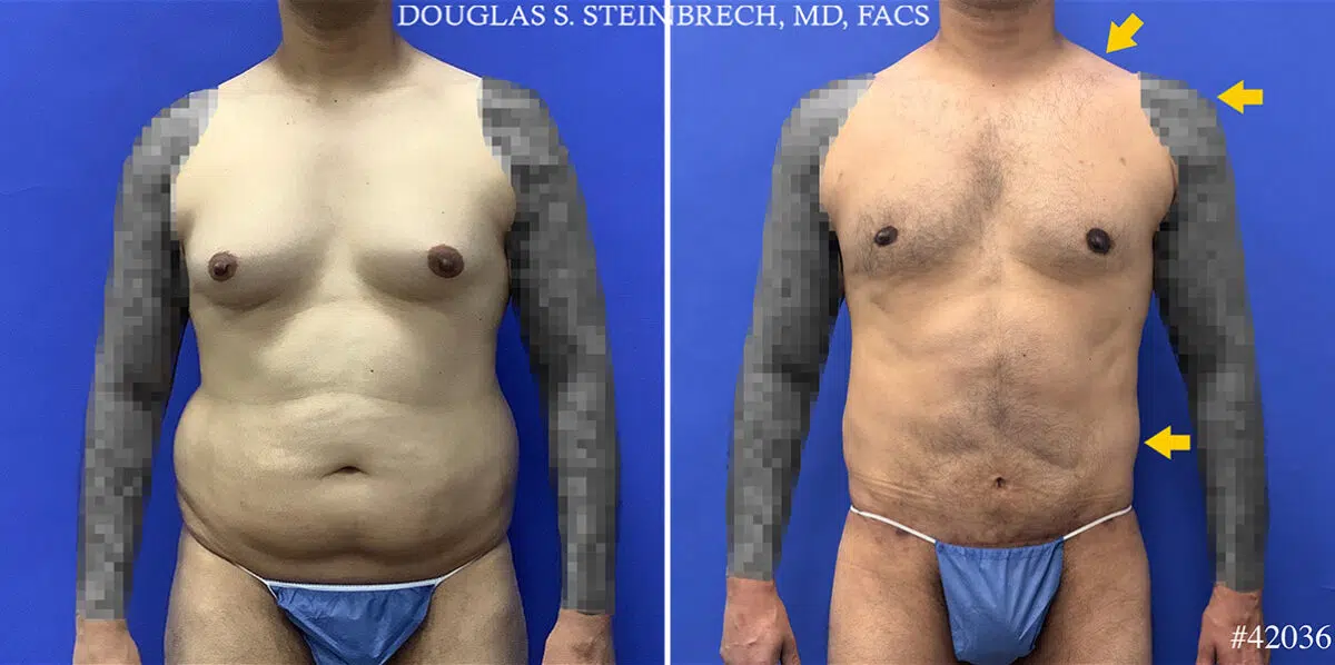 Body Banking Before and After Photos in CA, Beverly Hills, Patient 25324