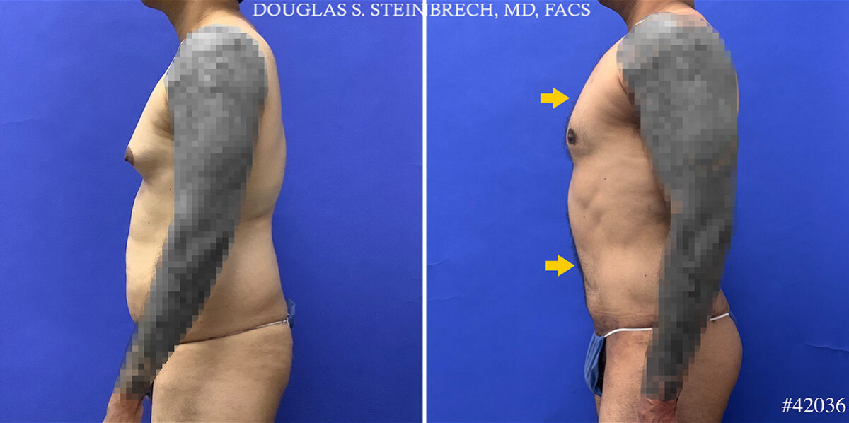 Body Banking Before and After Photos in CA, Beverly Hills, Patient 25324