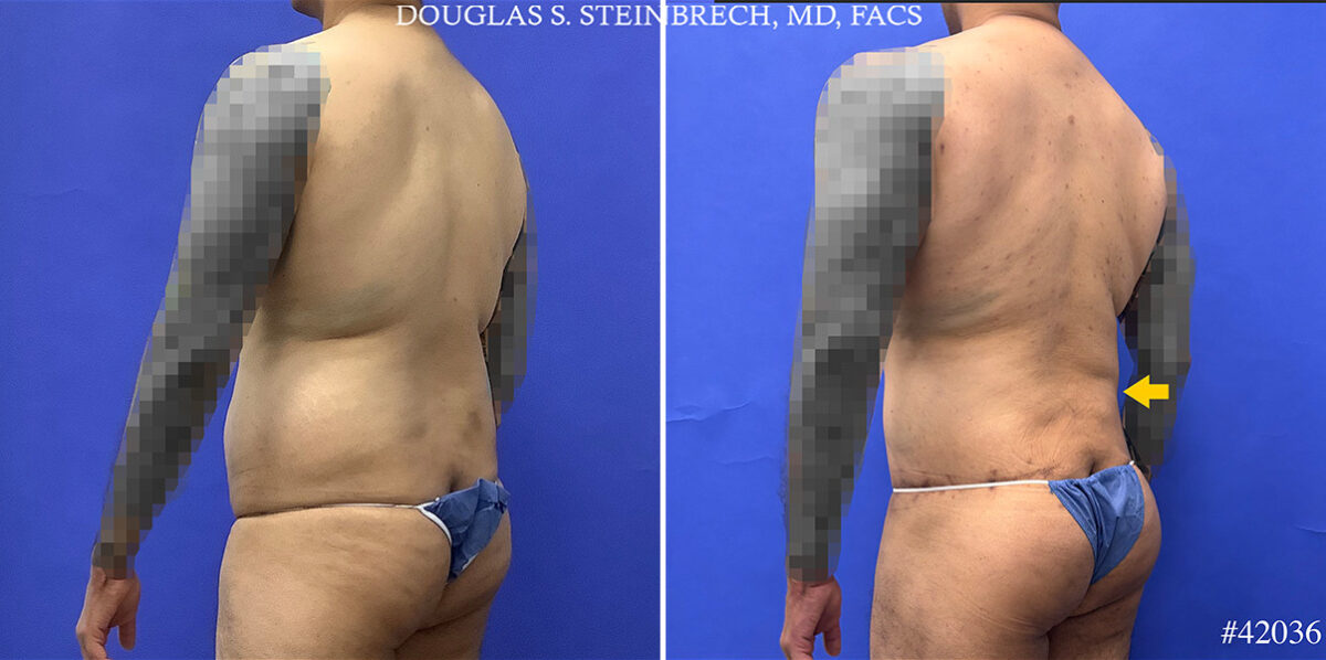 Body Banking Before and After Photos in CA, Beverly Hills, Patient 25324