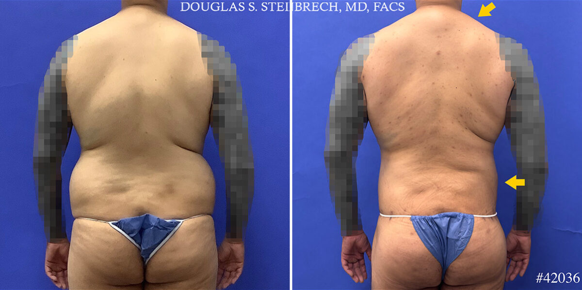 Body Banking Before and After Photos in CA, Beverly Hills, Patient 25324