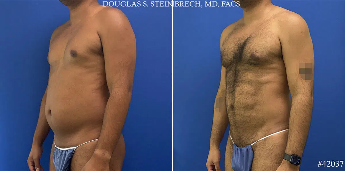 Body Banking Before and After Photos in CA, Beverly Hills, Patient 25340