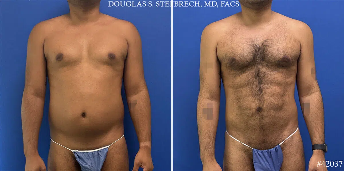 Body Banking Before and After Photos in CA, Beverly Hills, Patient 25340