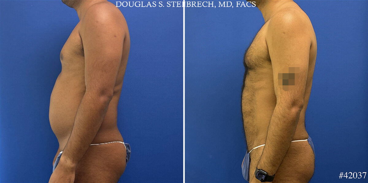 Body Banking Before and After Photos in CA, Beverly Hills, Patient 25340