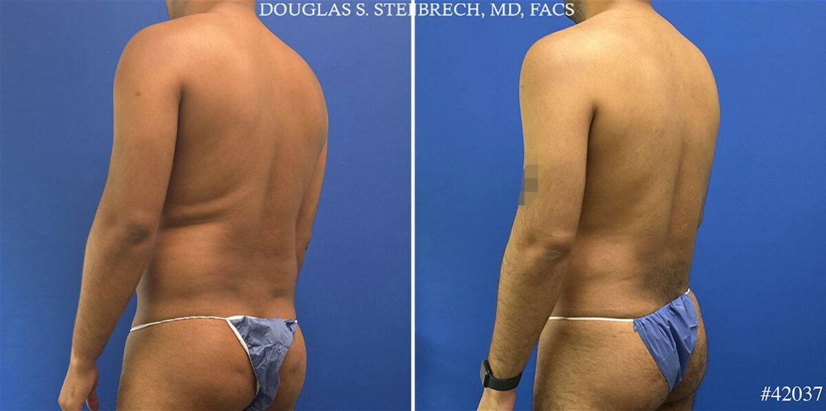 Body Banking Before and After Photos in CA, Beverly Hills, Patient 25340