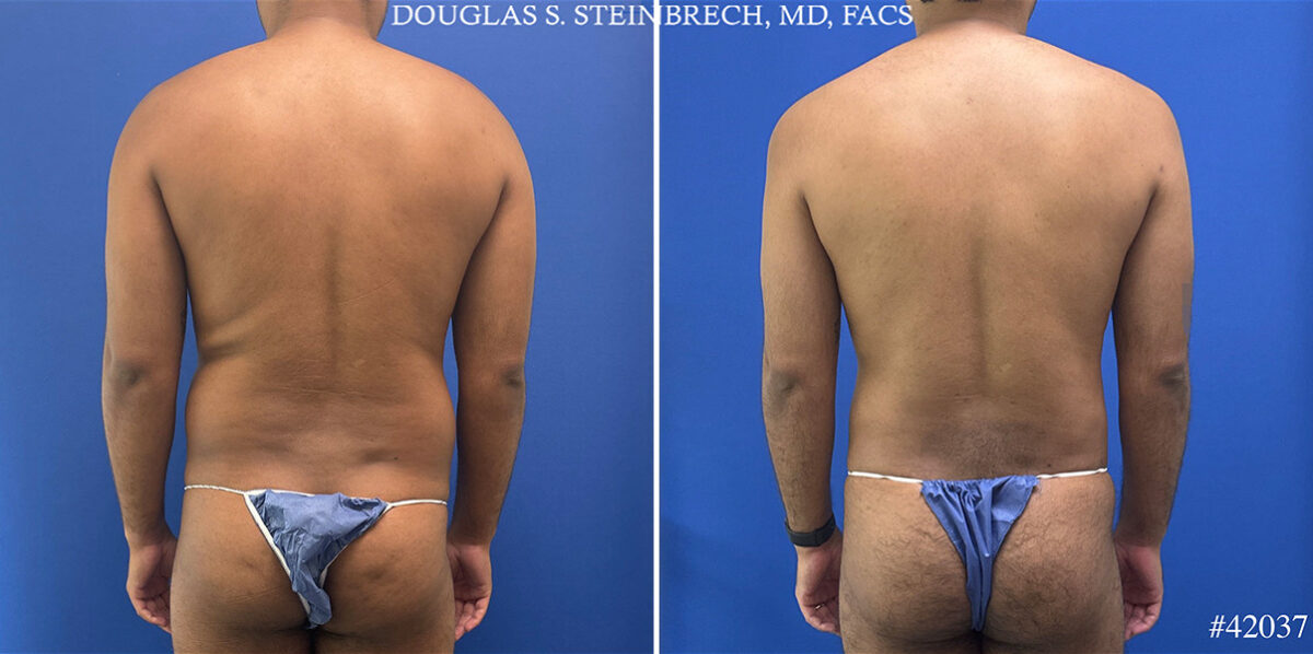 Body Banking Before and After Photos in CA, Beverly Hills, Patient 25340