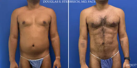 Body Banking Before and After Photos in CA, Beverly Hills, Patient 25340
