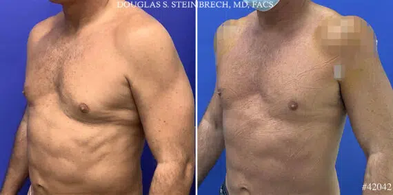 Alloclae Before and After Photos in CA, Beverly Hills, Patient 25499